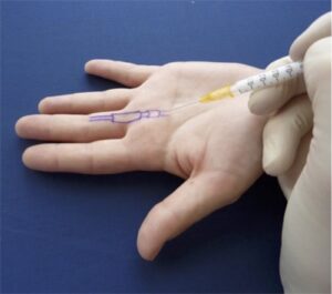 Trigger-Finger-Non-Surgical-Treatment