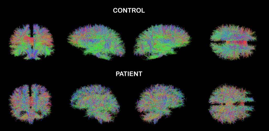 Cognitive Rehabilitation - Symptoms, Causes, Treatment 1 1. Symptoms
