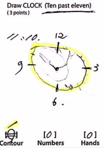 Cognitive Rehabilitation - Symptoms, Causes, Treatment 8 5 2. Treatment After Clock Drawing