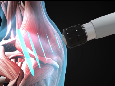 ESWT & RSWT Shockwave Therapy