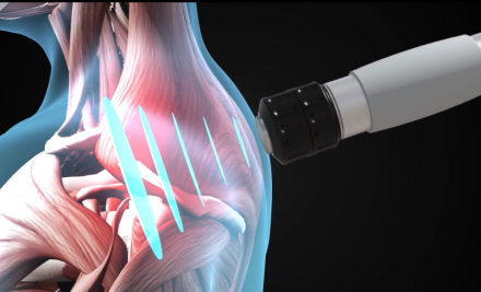 Extracorporeal Shockwave Therapy (ESWT) and Radial Shockwave Therapy (RSWT) in Physiotherapy