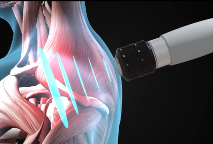 Extracorporeal Shockwave Therapy (ESWT) and Radial Shockwave Therapy (RSWT) in Physiotherapy
